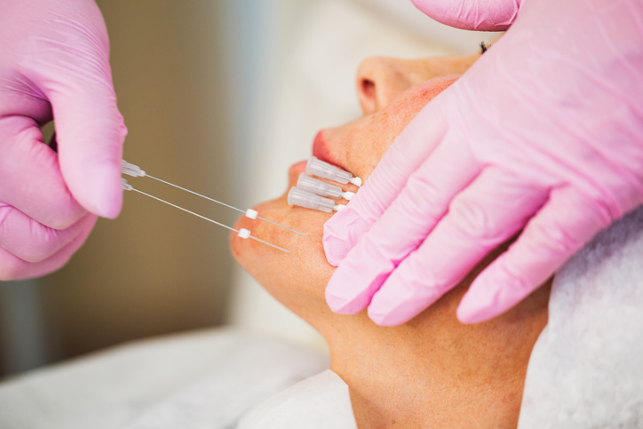 Close-up of a woman receiving a cosmetic thread lift (PDO threads) on chin and jawline by clinician in pink gloves