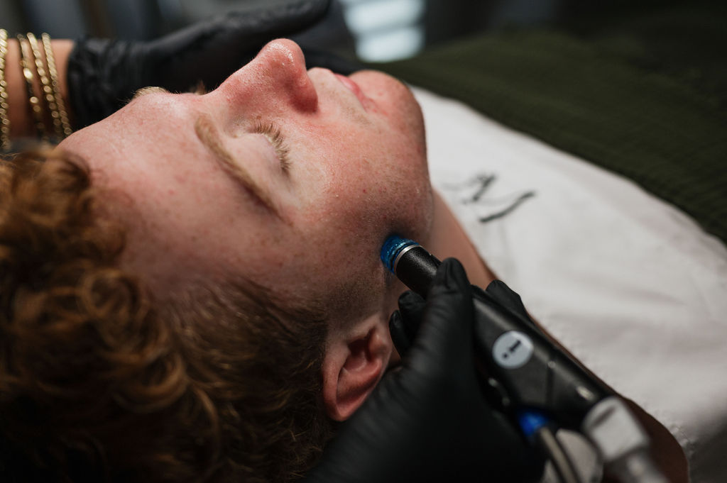 Man receiving microneedling facial treatment along jawline with technician wearing black gloves