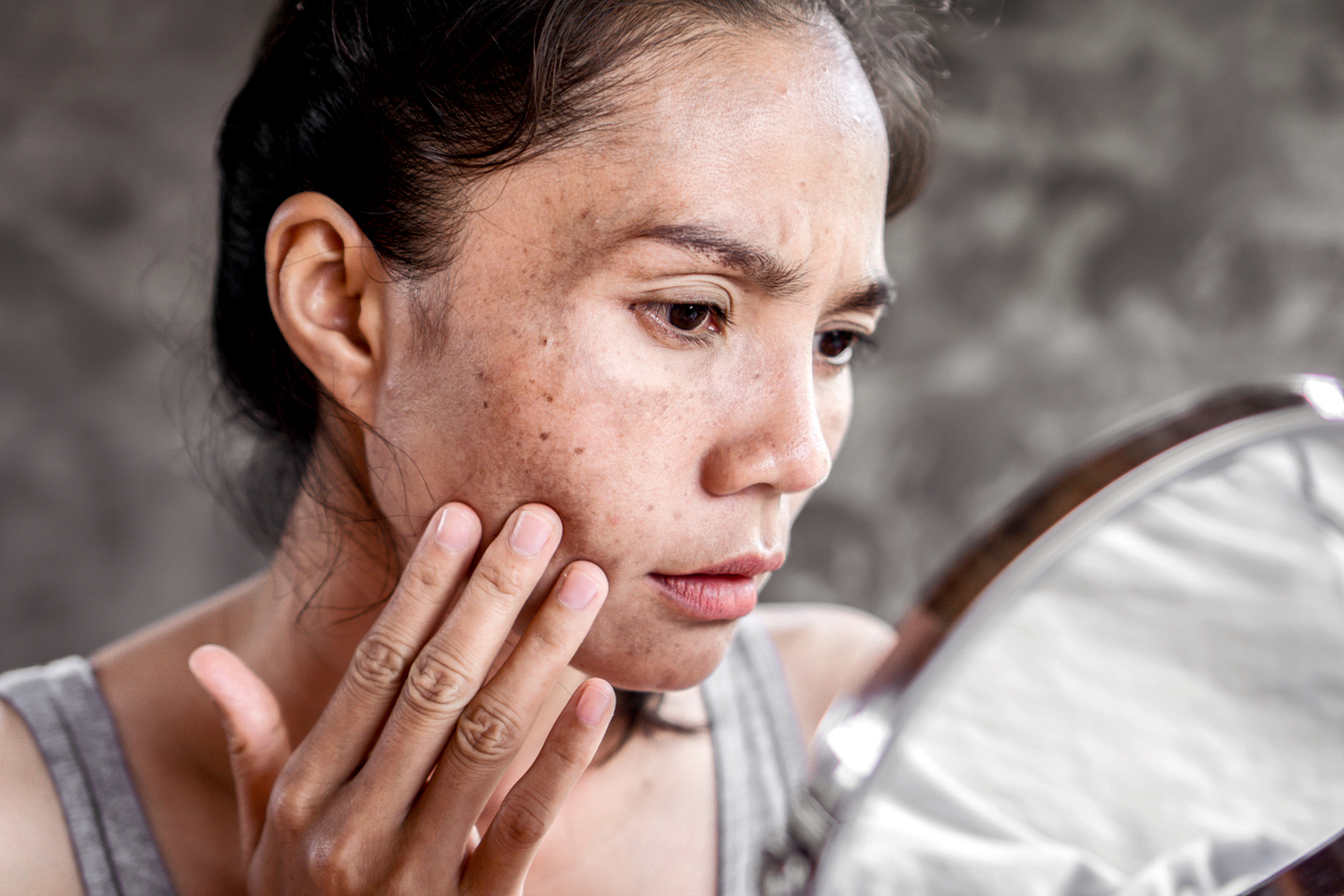 Close-up of woman examining acne and dark spots in mirror, touching her cheek with a concerned expression