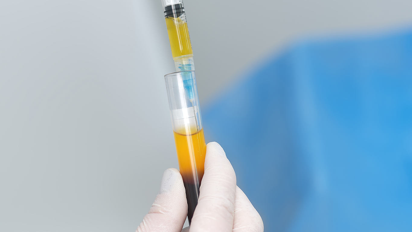 a person's gloved hand holding a test tube of blood and yellow plasma with a syringe in a clinical lab setting