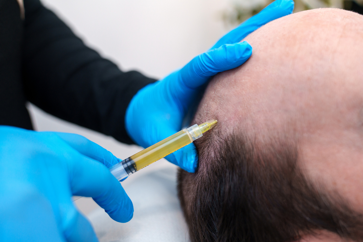 Medical professional injects platelet-rich plasma into man's scalp for hair restoration