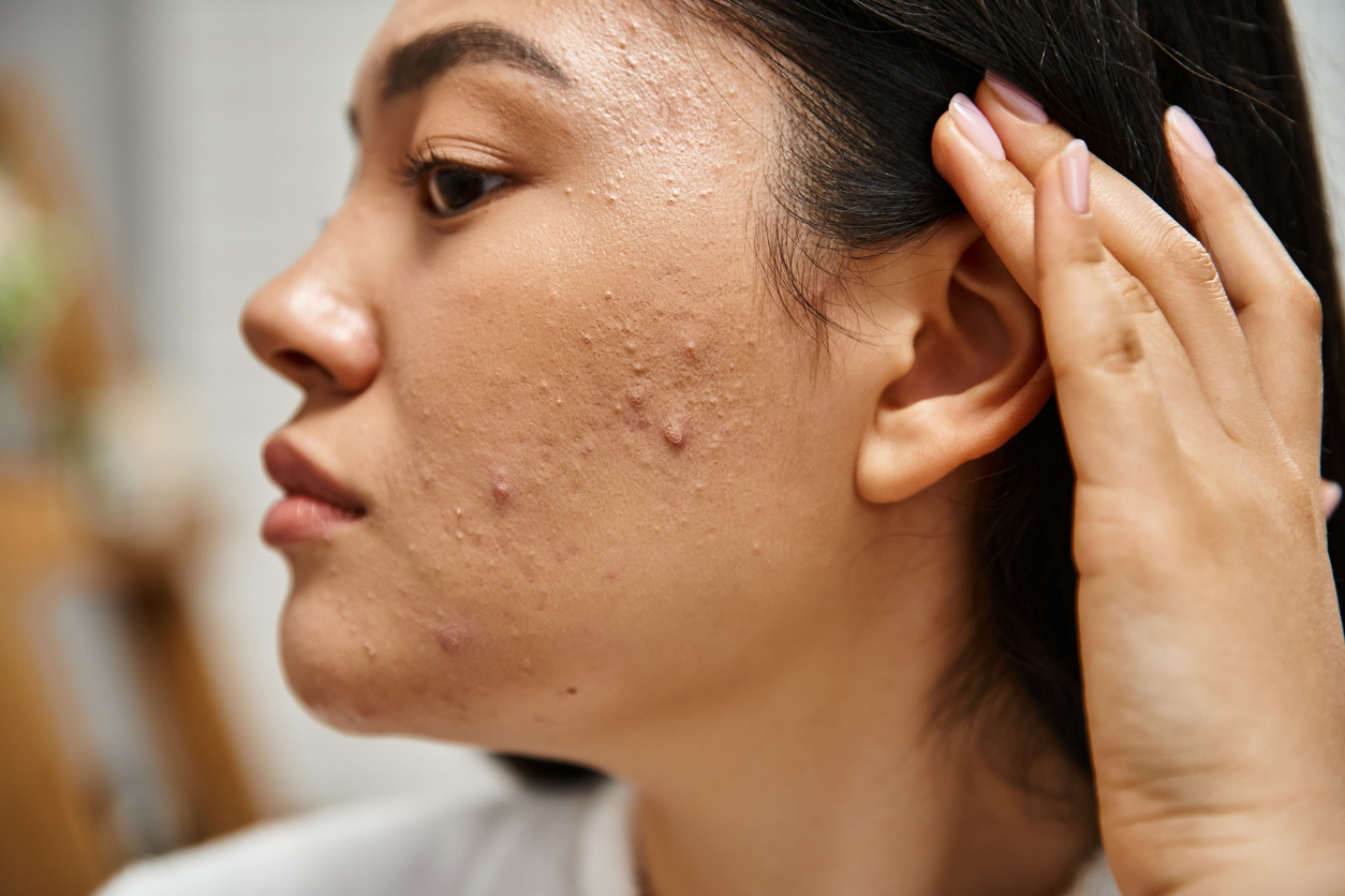 Close-up of a woman with acne and textured skin on her cheek, skincare concern and blemishes visible